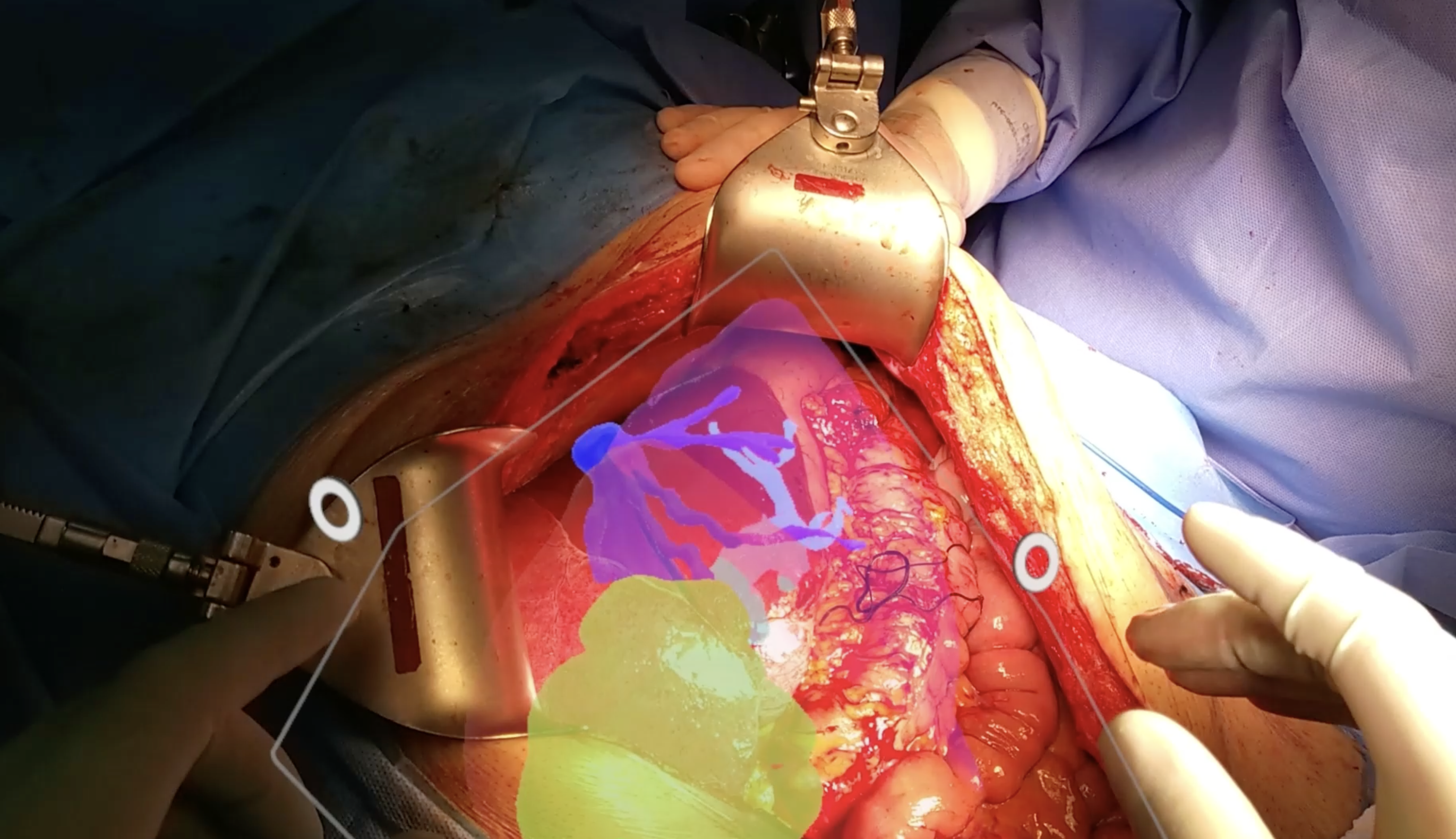 From Virtual Planning to Real Incision